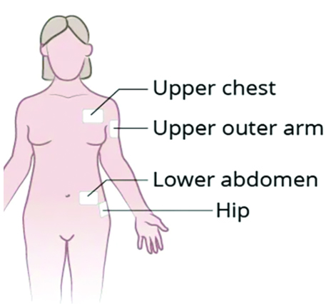 Diagram of a person with patch locations on the upper chest, upper outer arm, lower abdomen and hip