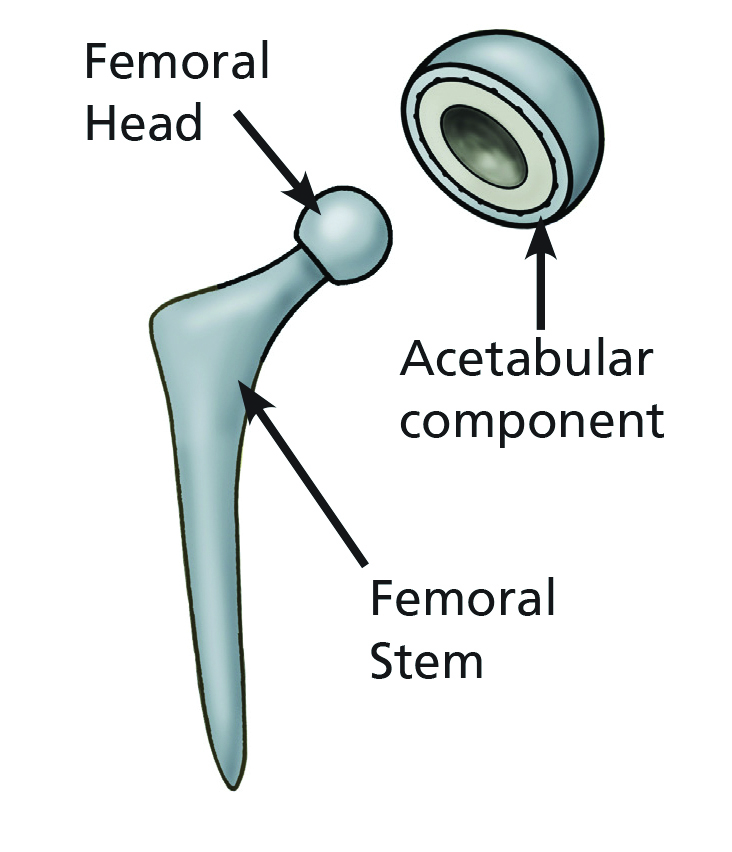 Image showing the components of a hip replacement; the femoral head, acetabular component and the femoral stem.