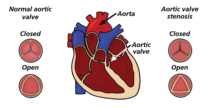 Illustration of a normal aortic valve shown closed and open. Illustration of a cross section of the heart showing the aorta and the aortic valve. Illustration of a aortic valve stenosis, shown closed and open.