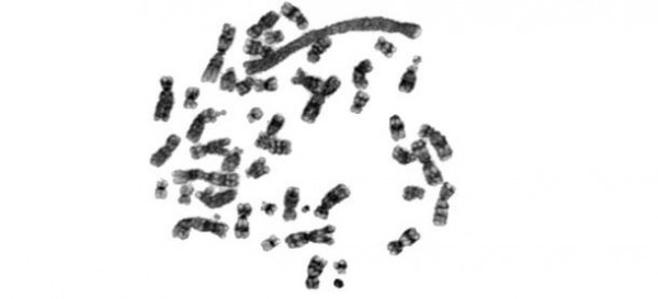 G-banding showing large marker chromosome containing MDM2 amplification in well-differentiated liposarcoma