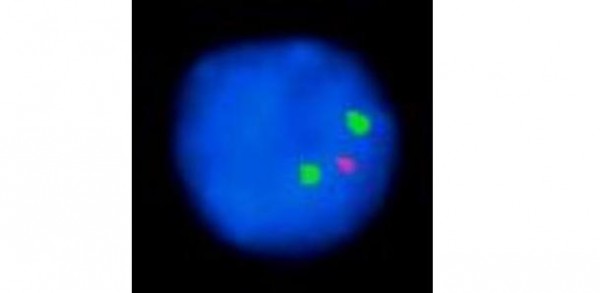 FISH showing 13q14 deletion in spindle cell lipoma