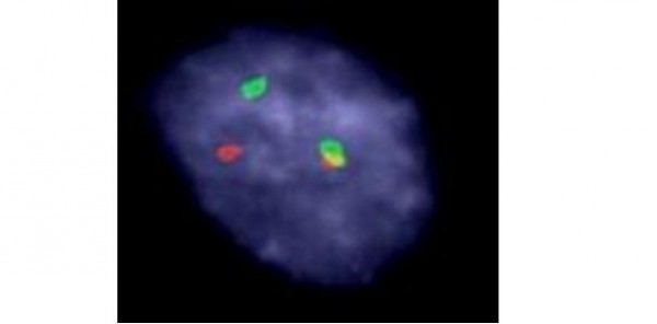 &nbsp;FISH showing EWSR1 rearrangement in Ewing&rsquo;s sarcoma