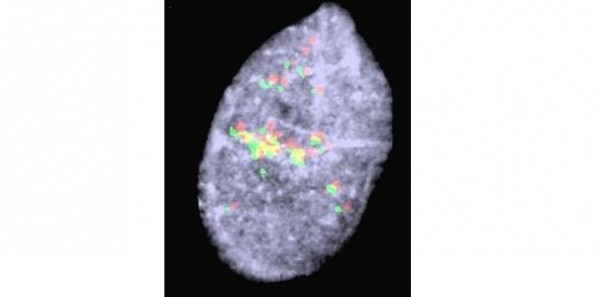 FISH showing PAX-FOXO1 amplification in alveolar rhabdomyosarcoma