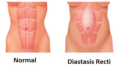 diastasis recti