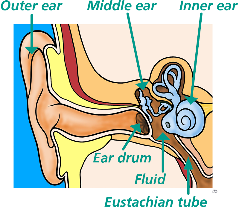 Illustration showing how glue ear affects your child's hearing.