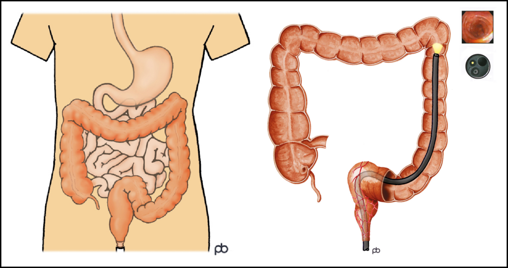 A pair of images showing the large intestine. An example of the camera in the bowel is shown in the right image.