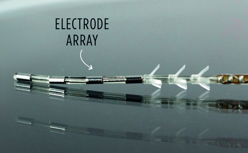 Image of PNS implantable lead.