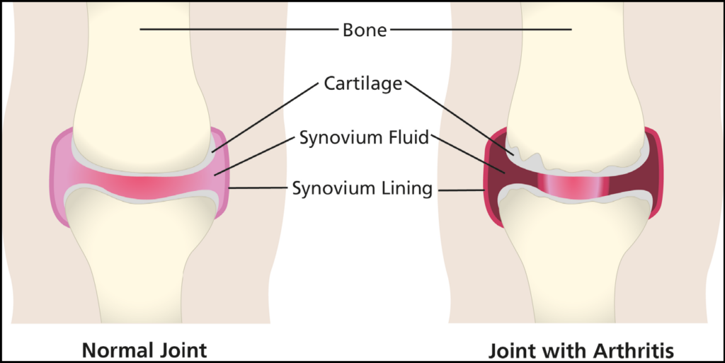 Image shows the anatomy of a knee joint comparing a normal joint, to a joint with arthritis.
