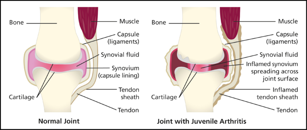 The image shows the difference between a normal joint, and a joint with juvenile arthritis