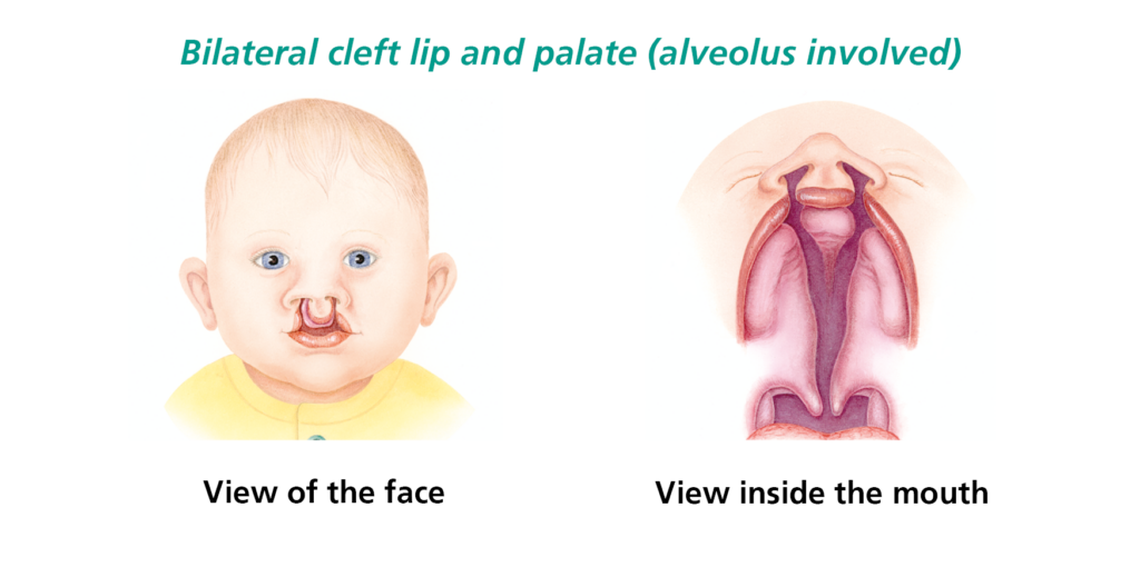 This picture shows a picture of a babies face with a bilateral cleft lip and palate and a view inside the mouth.