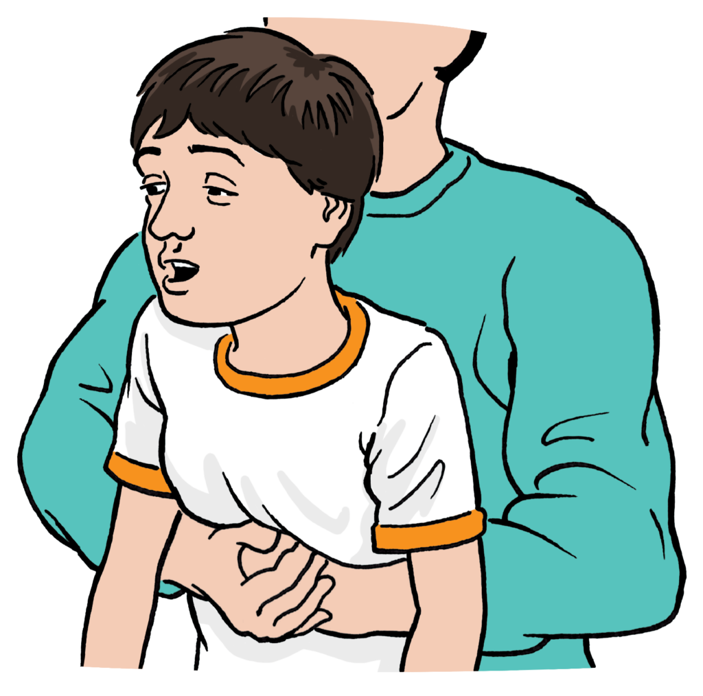 An adult giving up to 5 abdominal thrusts as the child is still choking.