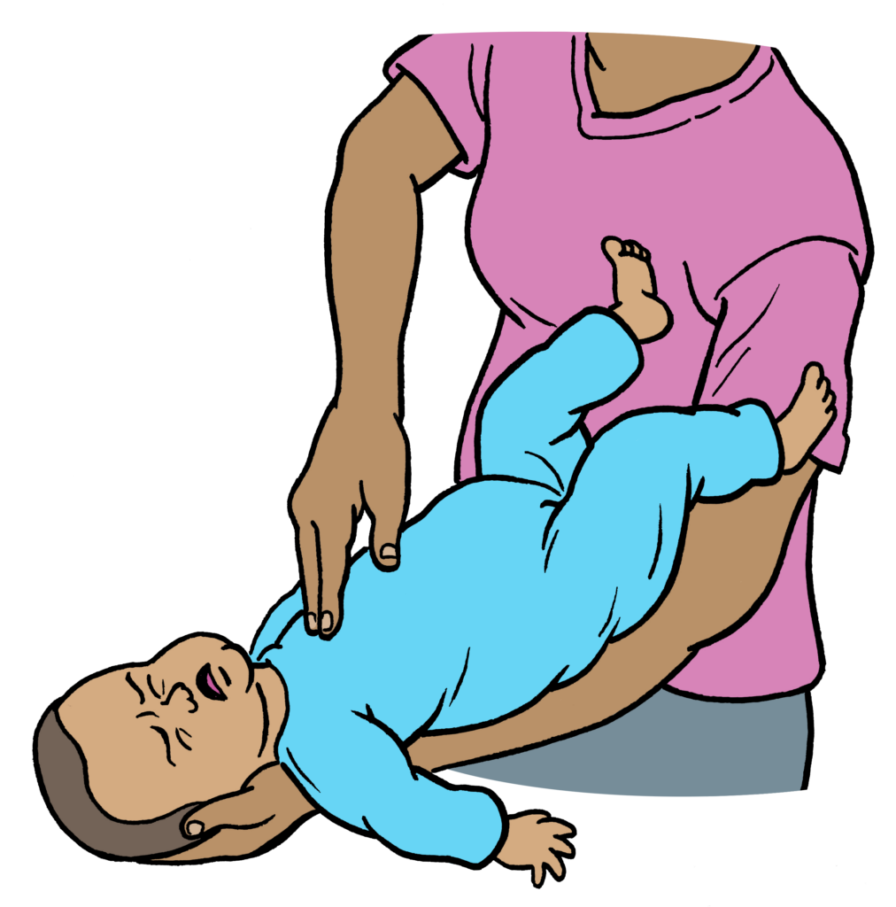An adult giving up to 5 chest thrusts as the baby is still choking.