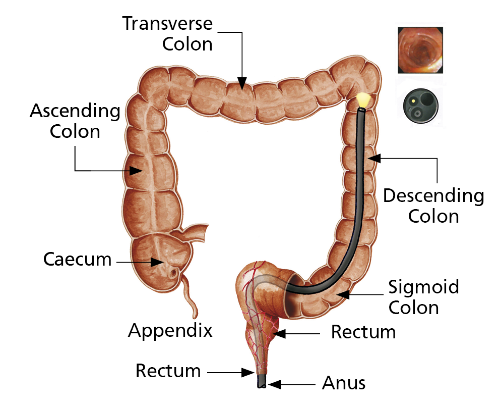 Illustration showing the different parts of the colon, and how the flexible tube from the camera is passed through the anus and up into the colon