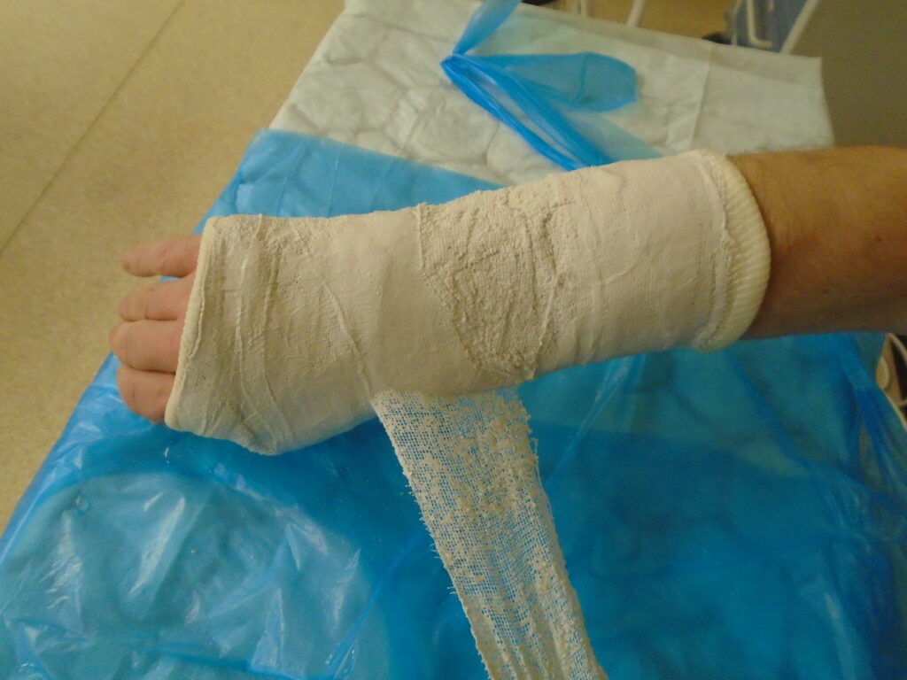 An image of the cast being unwound.