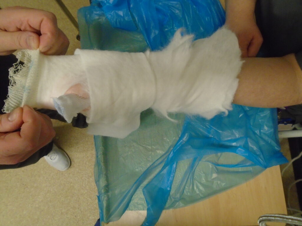 An image showing the removal of the wool layer and the stockinette.