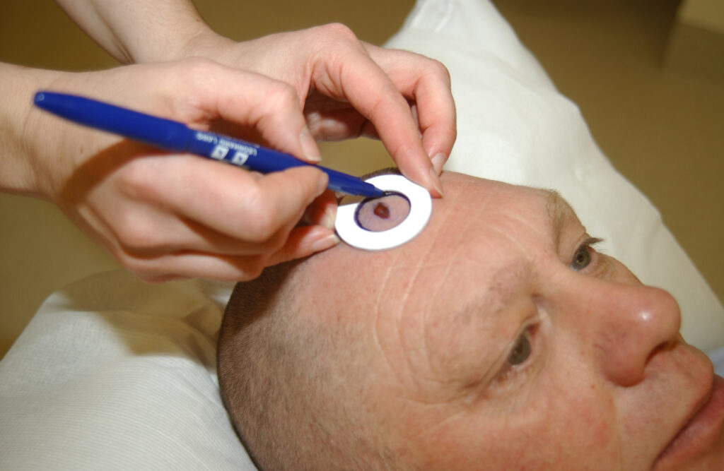 A photograph of a patient, showing the area to be treated being drawn on using a skin marker pen.



These marks will be removed before you leave the department. 