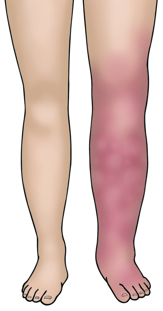 Illustration showing a pair of legs with right leg red and swollen.