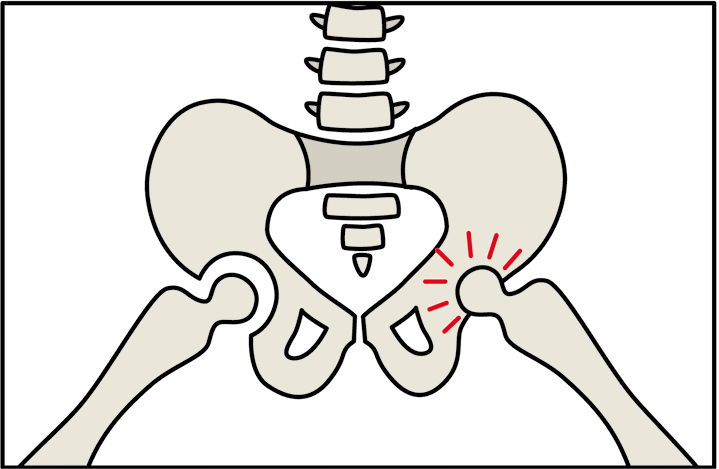 Dysplastic Hip