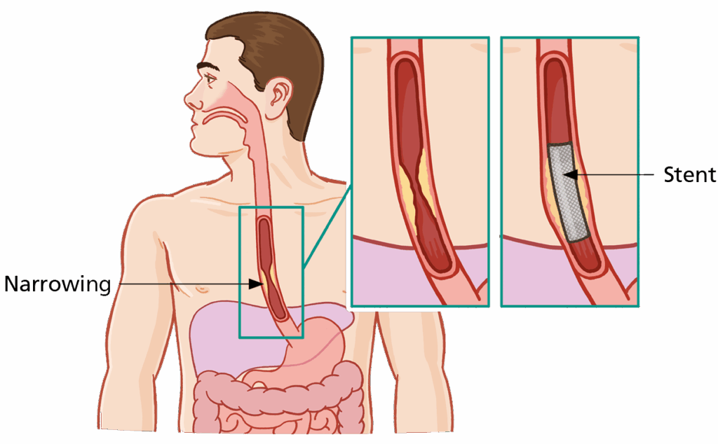 Illustration showing the narrowing of the oesophagus (gullet) and the placement of a stent.