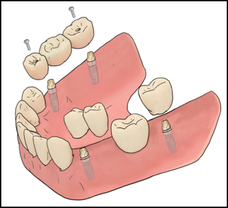 Illustration showing a fixed crown and bridge.
