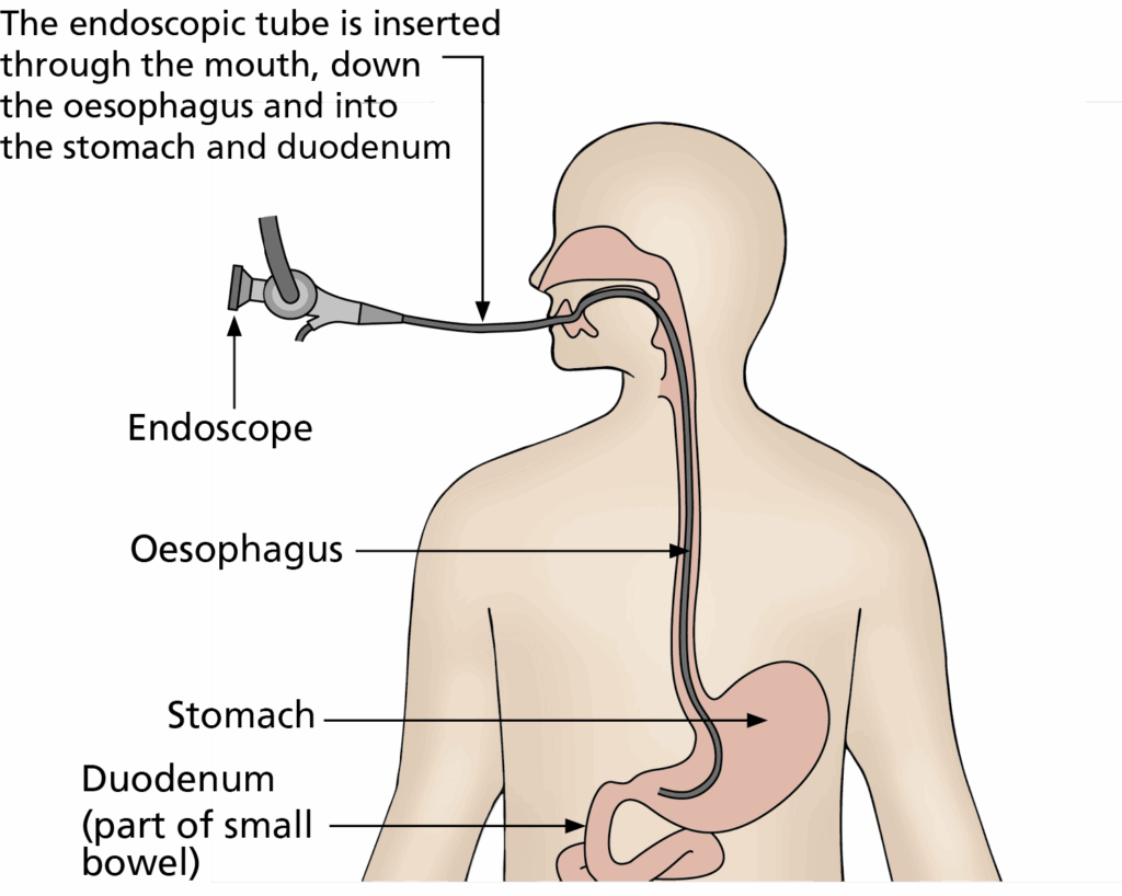 Illustration of the body showing the position of the Oesophagus, stomach and duodenum. It shows the endoscopic tube being passed through the mouth down the oesophagus and into the stomach and duodenum 
