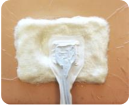 A photograph of the white PHMB gauze we use for Negative Pressure Wound Therapy and the suction port.