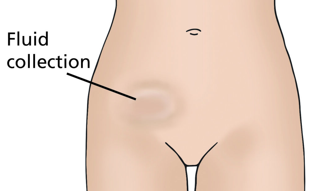 Illustration of pelvic area showing a circular bulge on lower left side where a lymphocyst may be. It is labelled fluid collection.
