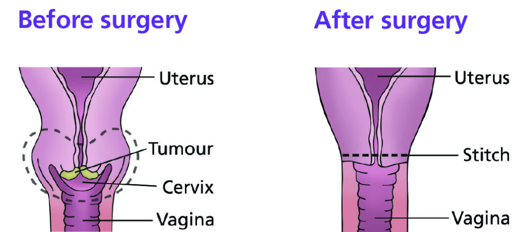 A close up diagram of a uterus and cervix showing where cervical tumour would be (before surgery). It has labels for the uterus, cervix, tumour and vagina. Next to this image is a close up diagram after surgery of a uterus and cervix showing where a stitch would be inserted around the opening to the uterus. It has labels for the uterus, stitch and vagina.