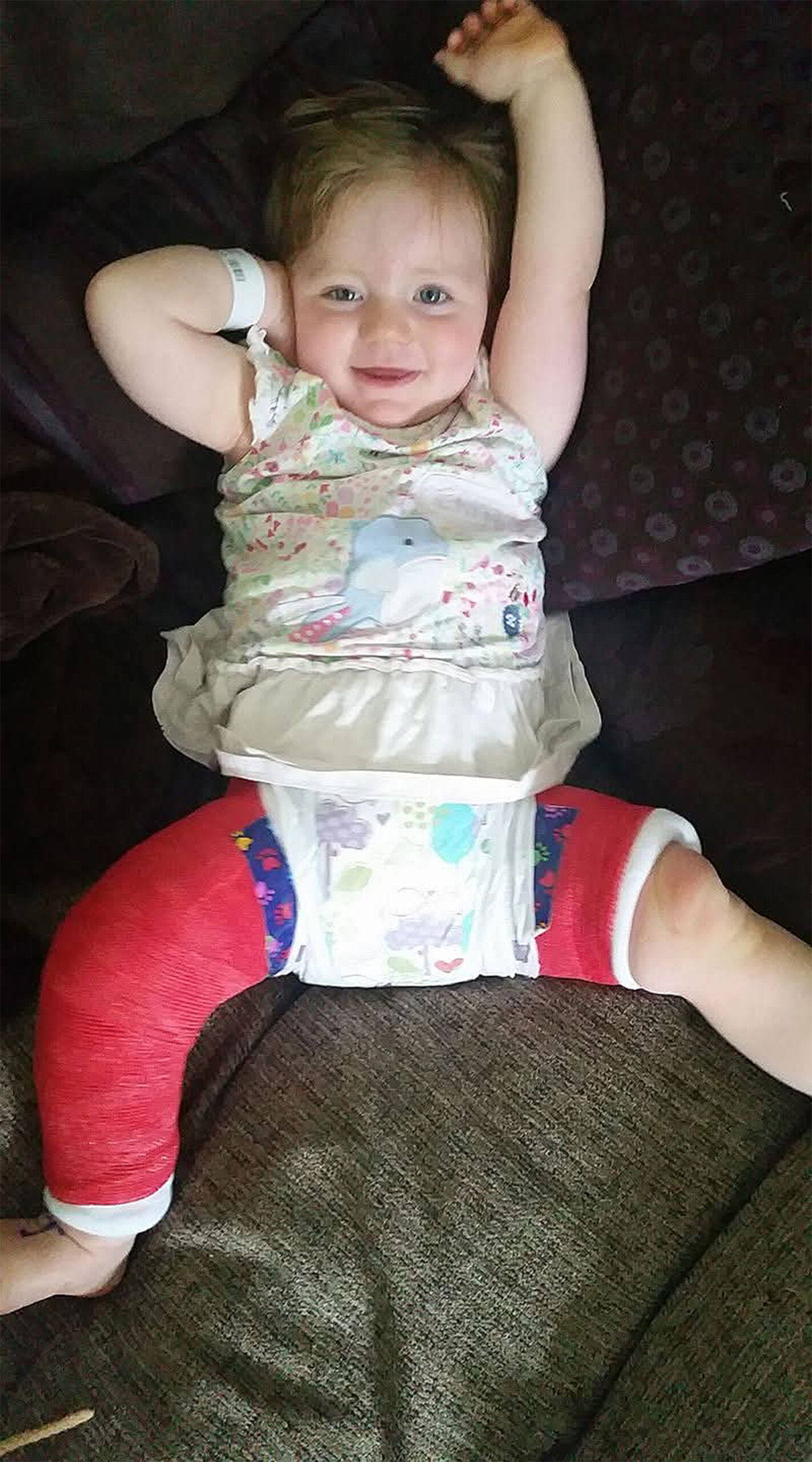 A Hip spica cast in use.