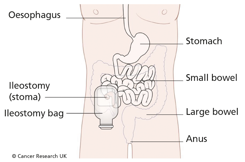 Image showing an Ileostomy on the surface of the abdomen.
