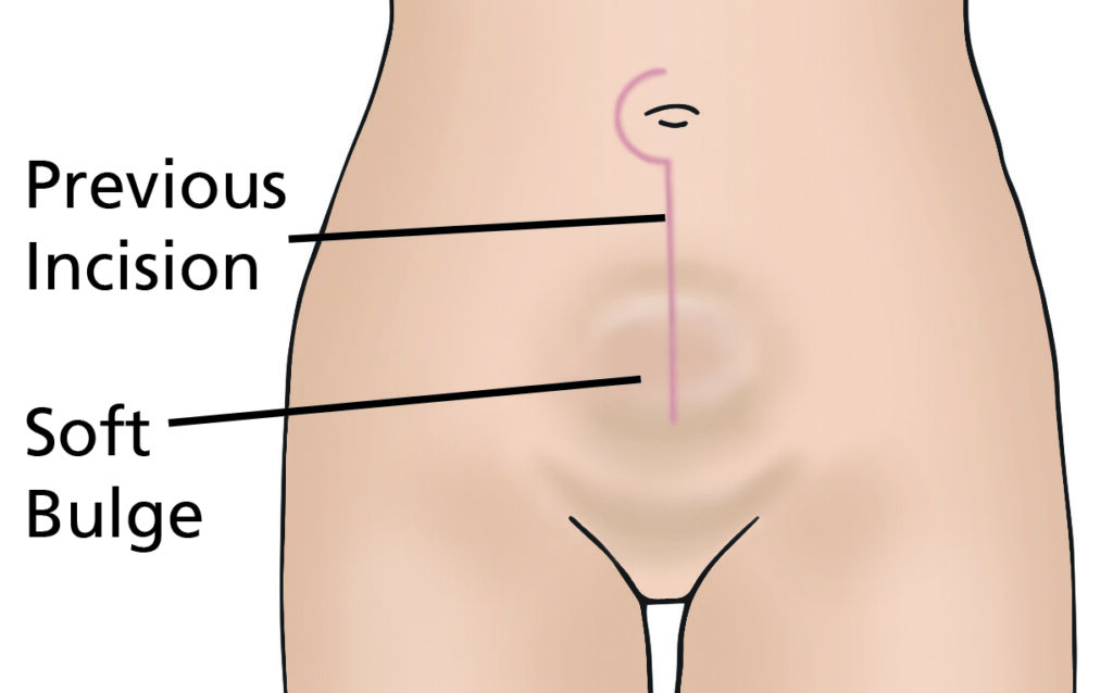 Illustration of pelvic area showing a circular bulge beneath the belly button and over the wound. It has labels for previous incision and soft bulge.