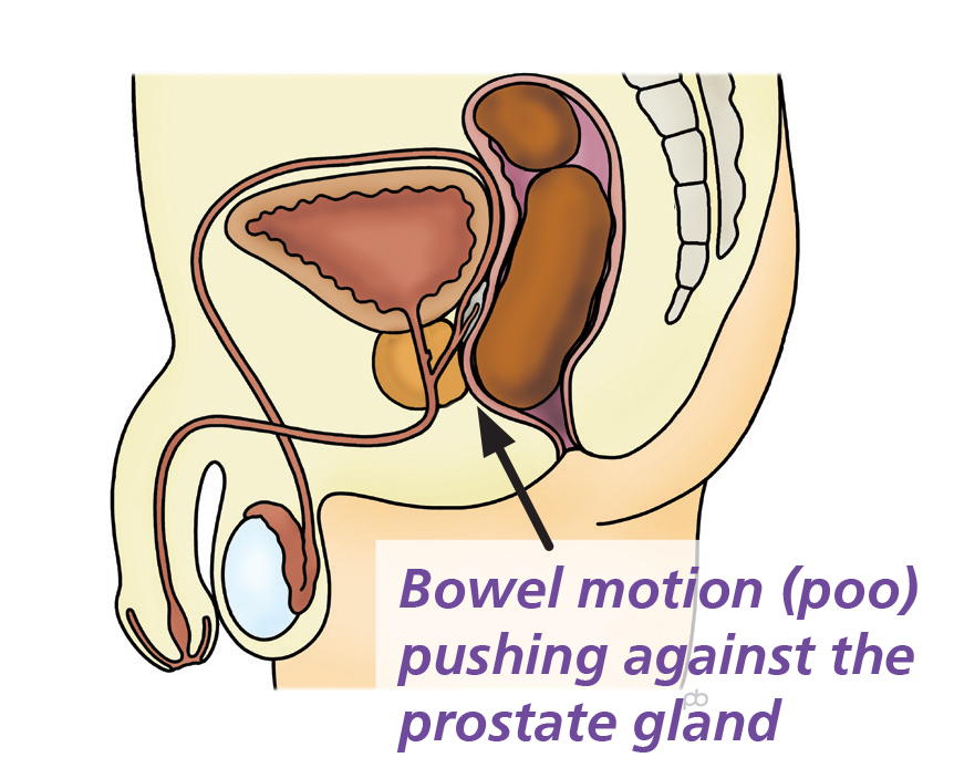 Image showing bowel motion (poo) pushing against the prostate gland. Some people&rsquo;s genitals may look different to this, due to surgery, medical or congenital conditions etc.