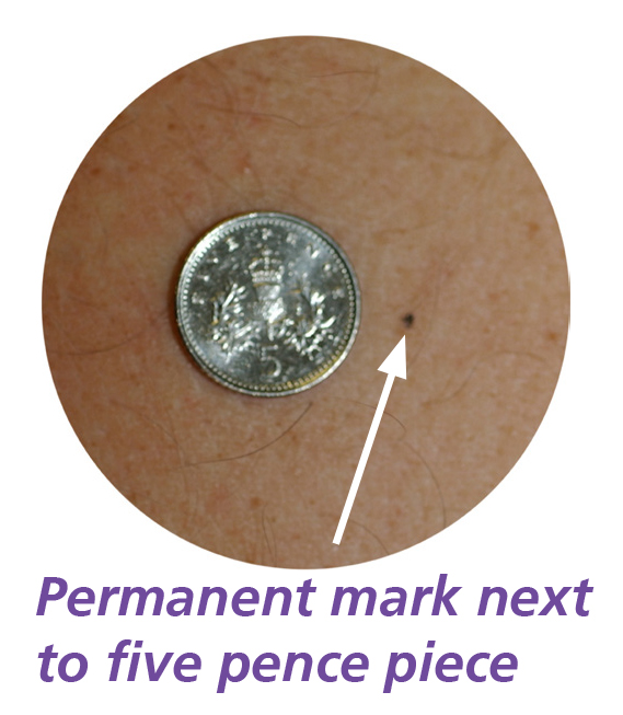 Photograph of a permanent mark next to five pence piece.