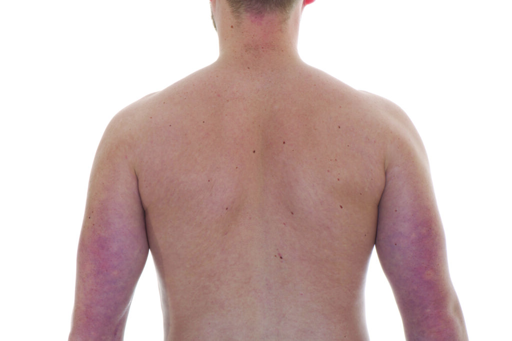 Photograph of a persons back with arms relaxed squeezing shoulder blades