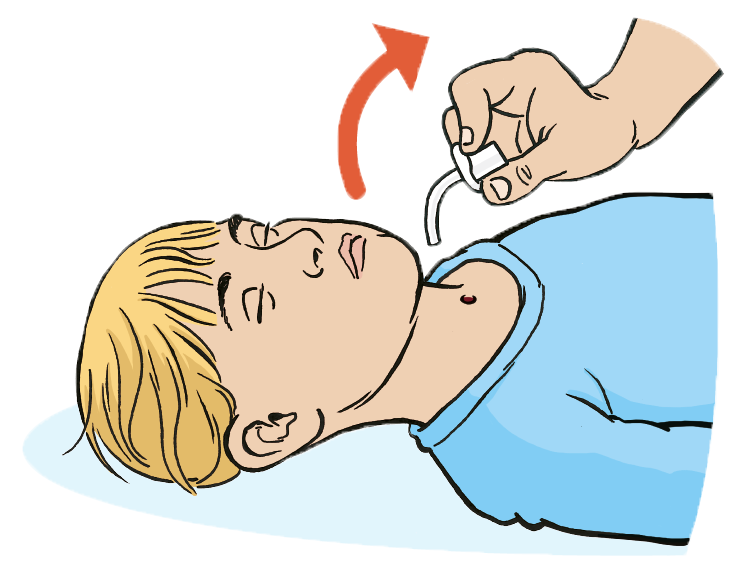 An image showing removing the blocked tube.