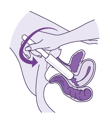An illustration showing a cross section of the lower body with the dilator being rotated inside the vagina.