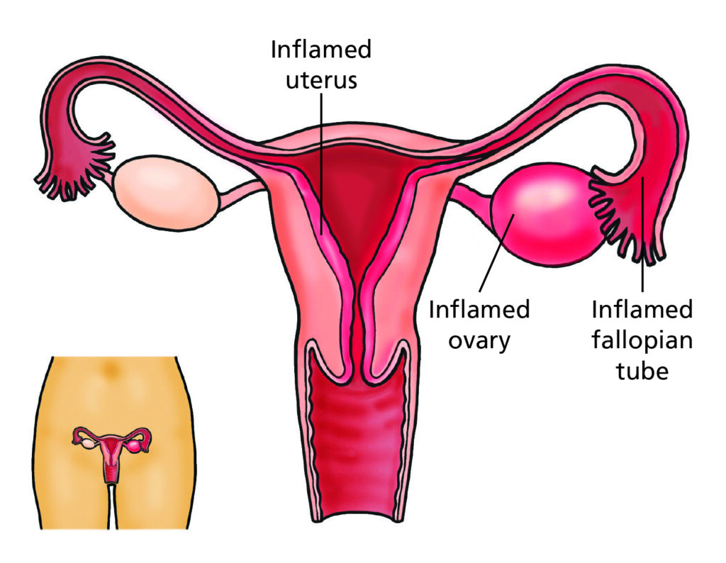 An image of the female reproductive system showing an inflamed uterus, inflamed ovary and inflamed fallopian tube.