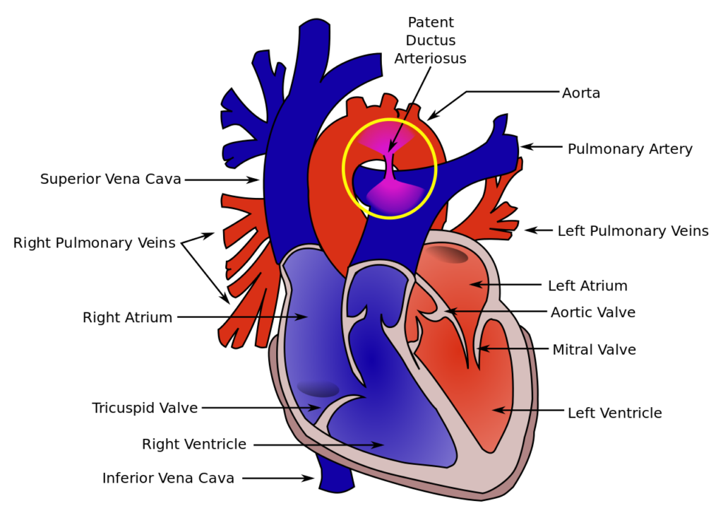Illustration of a cross section of the heart highlighting the patent ductus arteriosus