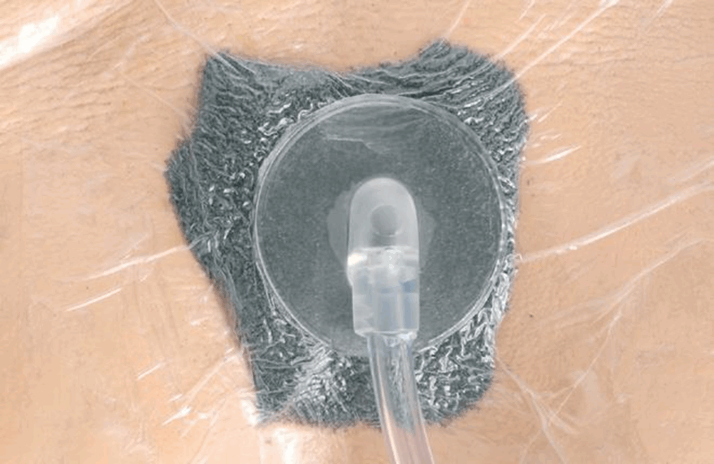 A photograph of the black foam we use for Negative Pressure Wound Therapy and the suction port.