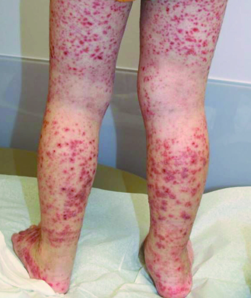 Photograph of a patients legs who has HSP.