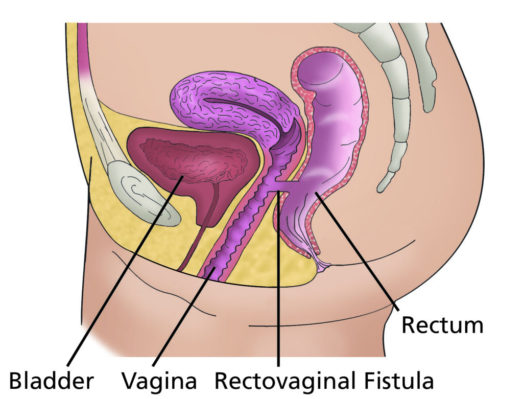 Illustration showing side view of pelvis and labelled bladder, vagina, rectovaginal fistula and rectum.
