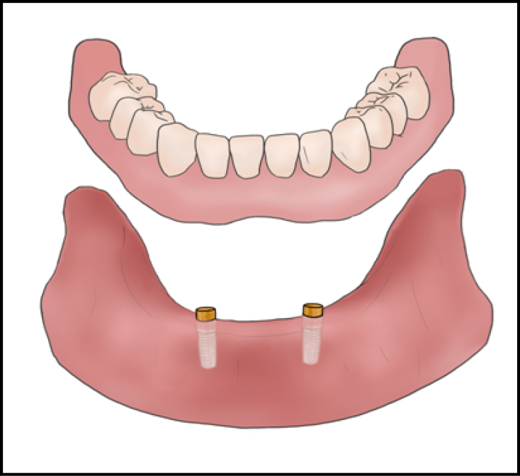 Illustration showing a removable overdenture.