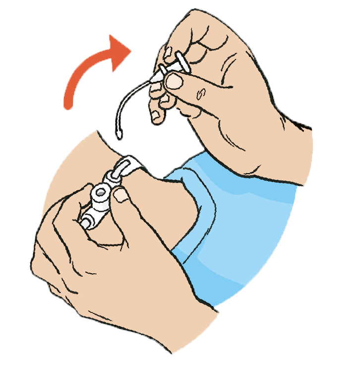 An image showing removing introducer and securing the tube with tapes.