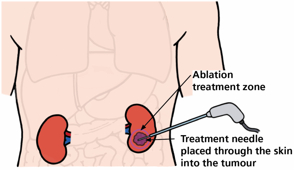Image shows the needle placement into the tumour and the treatment area