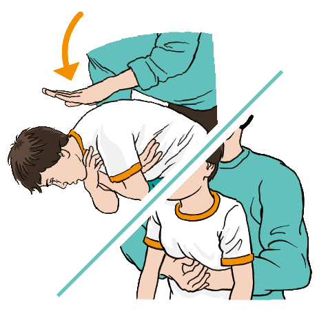 An adult repeating steps 4 and 5 as the child is still choking.