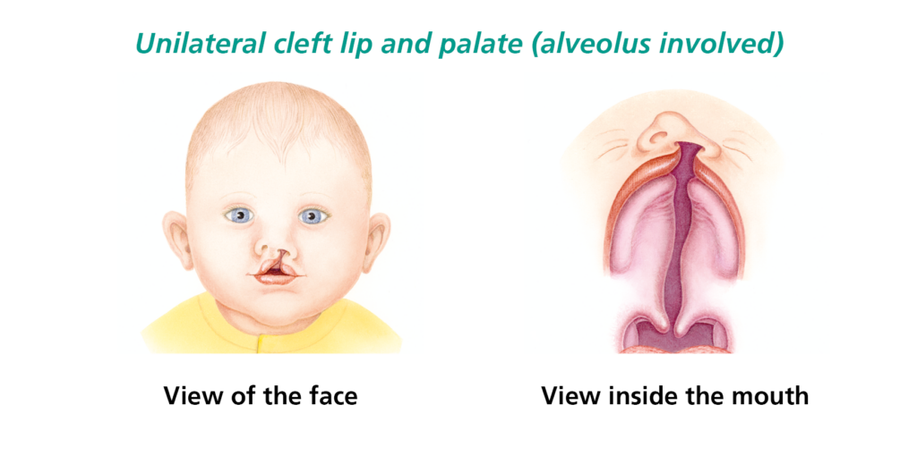 This picture shows a picture of a babies face with a unilateral cleft lip and palate and a view inside the mouth.