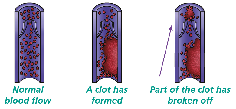 Illustration of a vein with normal blood flow, a clot forming and showing part of the clot breaking off.