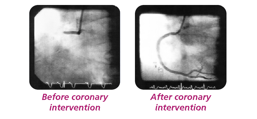 Photograph of a scan showing before and after coronary intervention