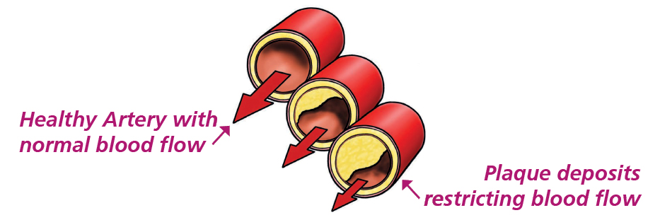 Illustration of the coronary arteries, showing a healthy artery with normal blood flow and Plaque deposits restricting blood flow