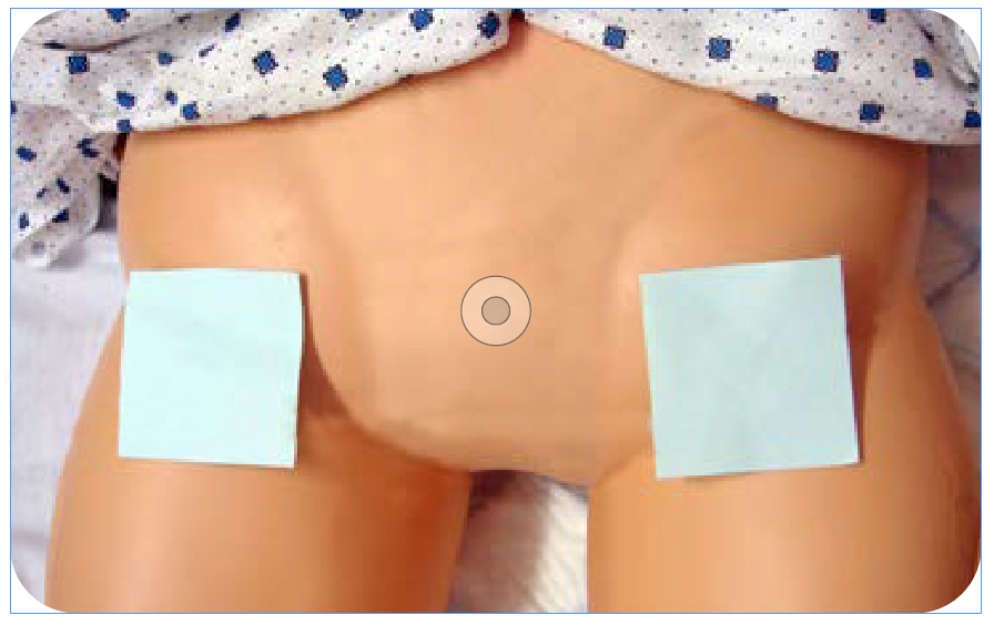 Photograph of a doll with patches to show area to be shaved around the groin area